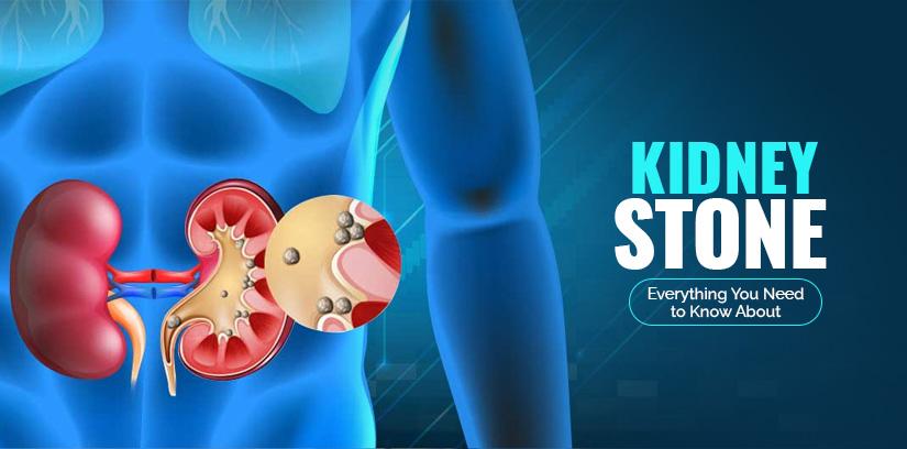 Kidney Stone: Everything You Need to Know About