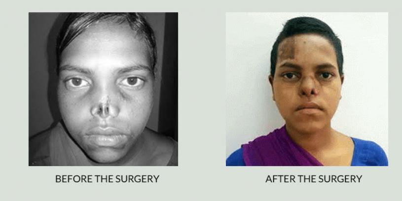 Leela finds back her beauty after Nose Reconstruction Surgery