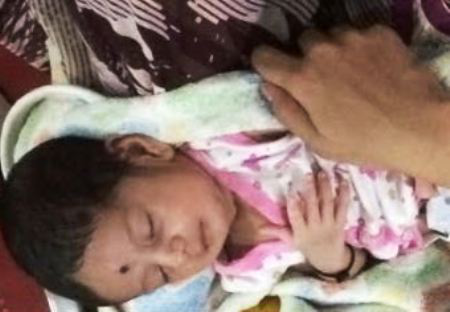 Neonate operated for Duodenal Atresia
